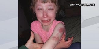 Lillian Waldron is pictured with wounds and bruises after another girl was biting her while sitting on the school bus. (Photo courtesy of WBAY.com.)