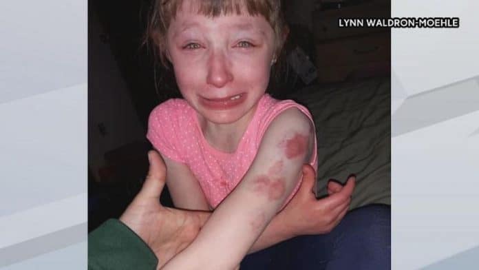 Girl bitten web Lillian Waldron is pictured with wounds and bruises after another girl was biting her while sitting on the school bus. (Photo courtesy of WBAY.com.)